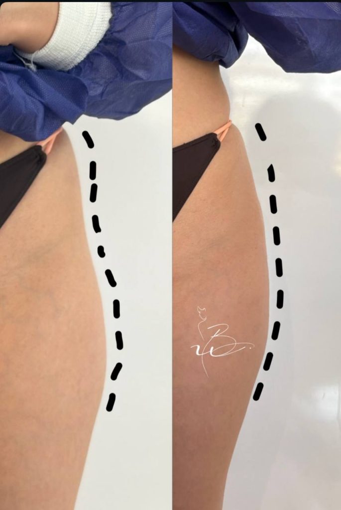 فیلرهیپدیپ