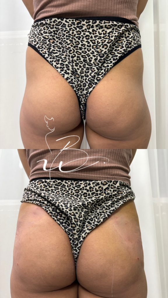 فیلرباسن وهیپ دیپ