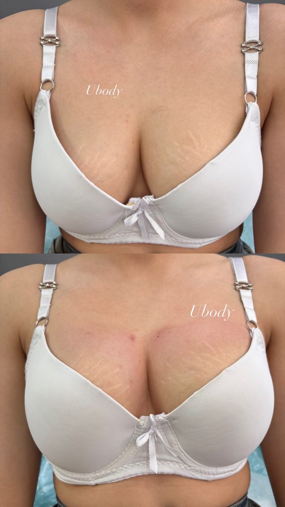 فیلرسینه درمشهد