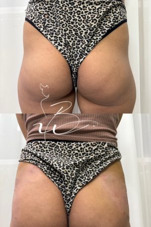 فیلرباسن وهیپ دیپ